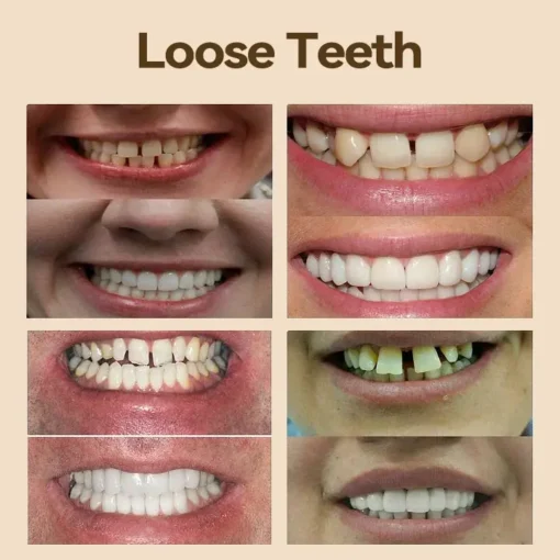 Hidone® Advanced Customized Full Denture Set - Image 4
