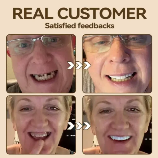 Hidone® Advanced Customized Full Denture Set - Image 5