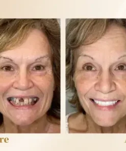 Hidone® –🦷Advanced Customized Full Denture Set🦷 (⏰Limited time discount last 30 minutes⏰)💎💎