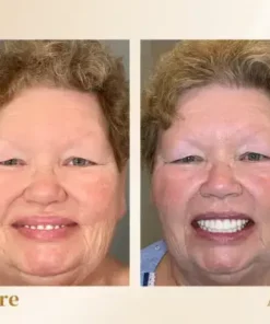 Hidone® –🦷Advanced Customized Full Denture Set🦷 (⏰Limited time discount last 30 minutes⏰)💎💎