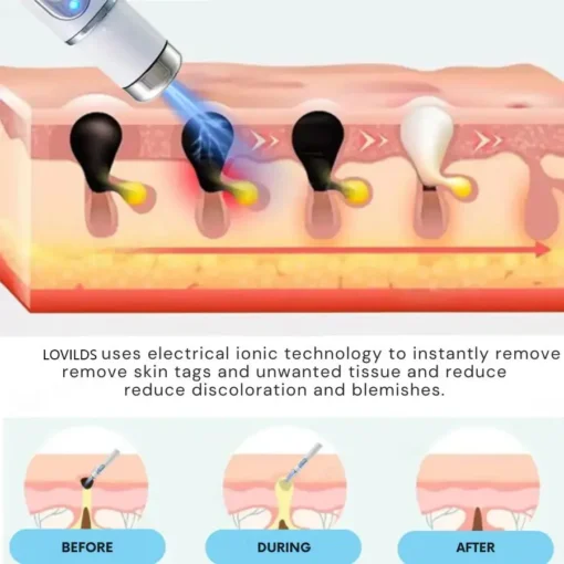 Hidone® 2-In-1 Non-Invasive Laser Pen
